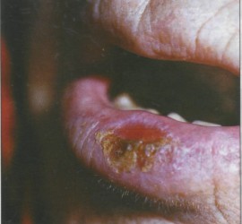 Абразивный хейлит Манганотти