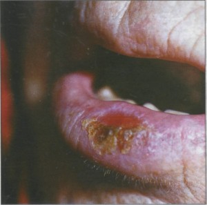 Абразивный хейлит Манганотти