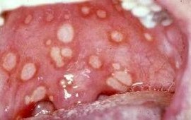 Афтоз Бехчета (синдром Турена)