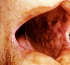 Анемия пернициозная (Аддисона-Бирмера)