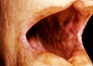 Анемия пернициозная (Аддисона-Бирмера)