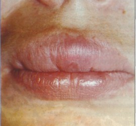 Ангионевротический отек Квинке