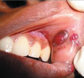 Ангиосаркома (злокачественная гемангиоэндотелиома)