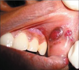 Ангиосаркома (злокачественная гемангиоэндотелиома)