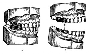 Аппарат Петросова
