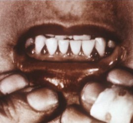 Барлова болезнь (детский скорбут)