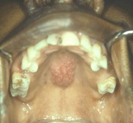 Бластомикоз