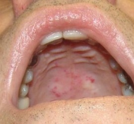 Болезнь Ослера-Рандю