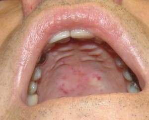 Болезнь Ослера-Рандю