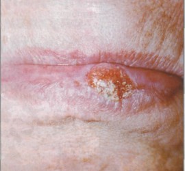 Бородавчатый предрак красной каймы губ