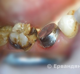 Кариес зубов