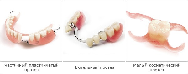 Рисунок 2 Частичные съемные акриловые зубные протезы [21]