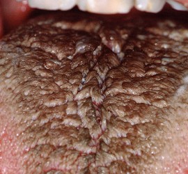 Черный «волосатый» (ворсинчатый) язык