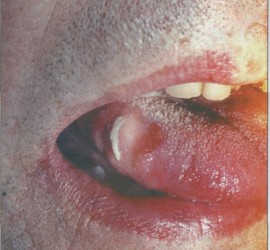 Декубитальная язва