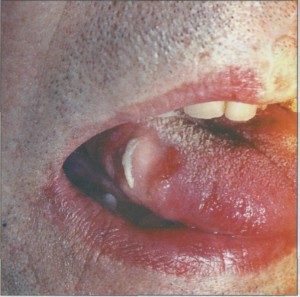 Декубитальная язва