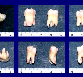 Зуб мудрости (dens serotinus)