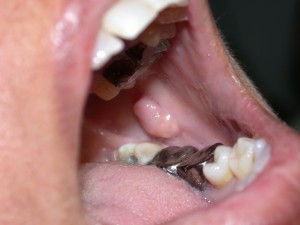 Фиброма щеки Фиброма щеки