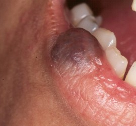 Гемангиома нижней губы