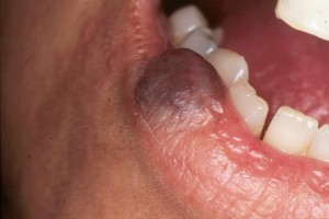 Гемангиома нижней губы