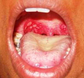 Герпангина