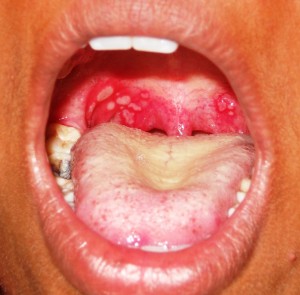 Герпангина