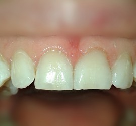 Гипоплазия - После