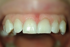 Коронка клиническая