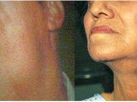 Острый гриппозный сиаладенит