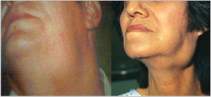 Острый гриппозный сиаладенит