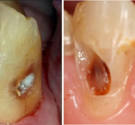 Кариес цемента