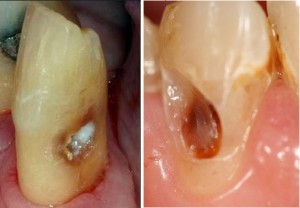 Кариес цемента