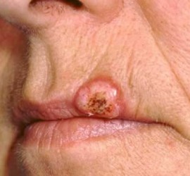 Кератоакантома