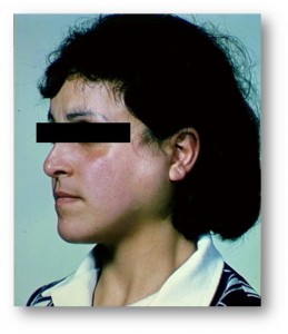 Хронический интерстициальный сиаладенит