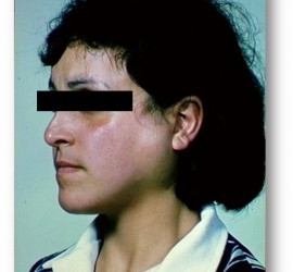 Хронический интерстициальный сиаладенит