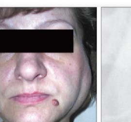 Хронический паренхиматозный сиаладенит