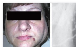 Хронический паренхиматозный сиаладенит