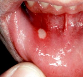 Стоматит хронический рецидивирующий афтозный