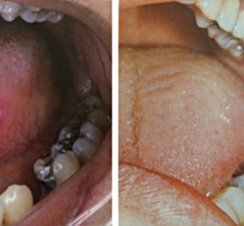 Красная волчанка