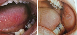 Красная волчанка