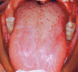 Красный плоский лишай