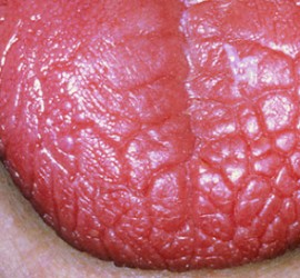 Ксеростомия