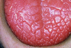 Ксеростомия