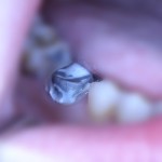 Фиксация культевой вкладки на цемент