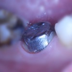 После ортопедического лечения культевой вкладкой