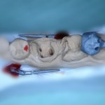 Отлитая культевая вкладка