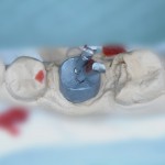 Припасованная культевая вкладка