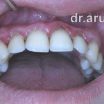 Лечение пародонтита - исходная ситуация