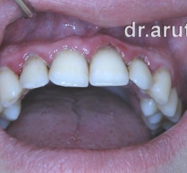 Лечение пародонтита - исходная ситуация