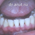 Неделю спустя после лечения