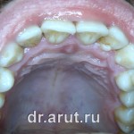 Лечение пародонтита - исходная ситуация